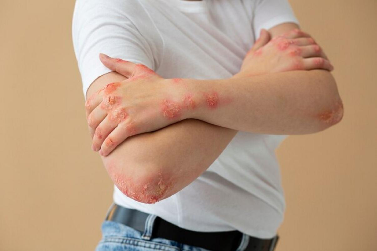 Urticaire : allergie de la peau aux multiples origines